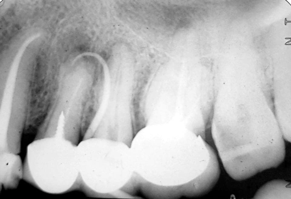 Radiografia con il tracciante che segue la fistola fino alla radice del dente