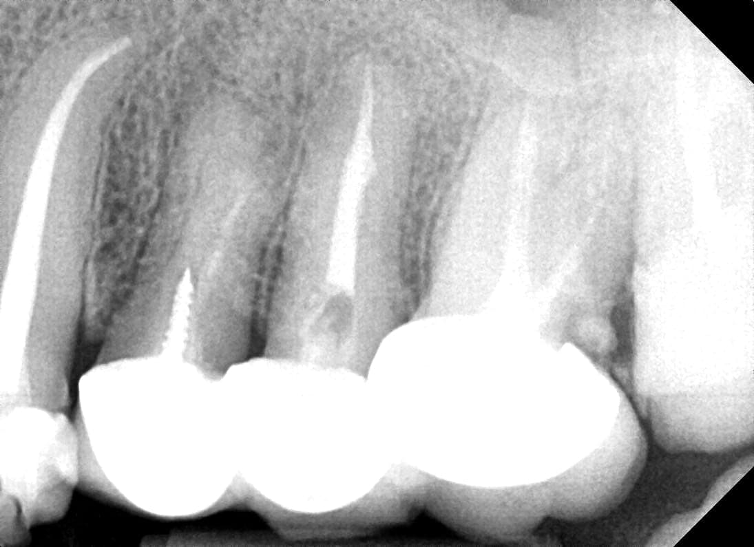 Radiografia degli stessi denti dopo l'apicectomia e il ritrattamento