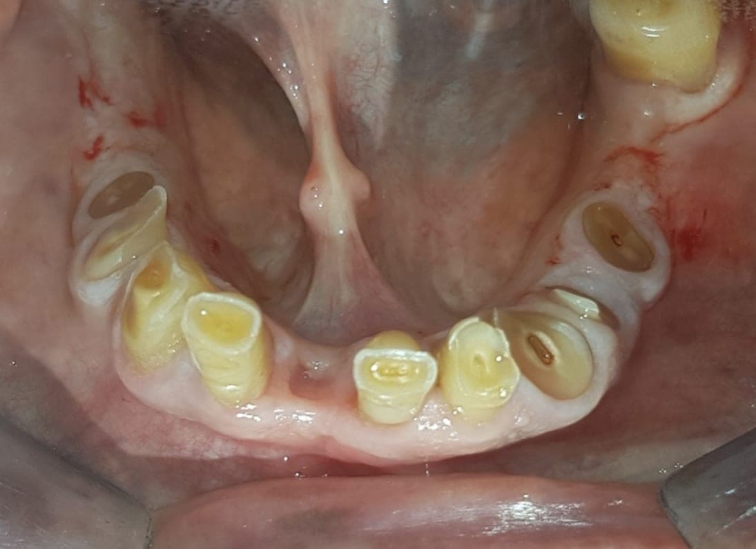 Arcata inferiore con i denti residui compromessi