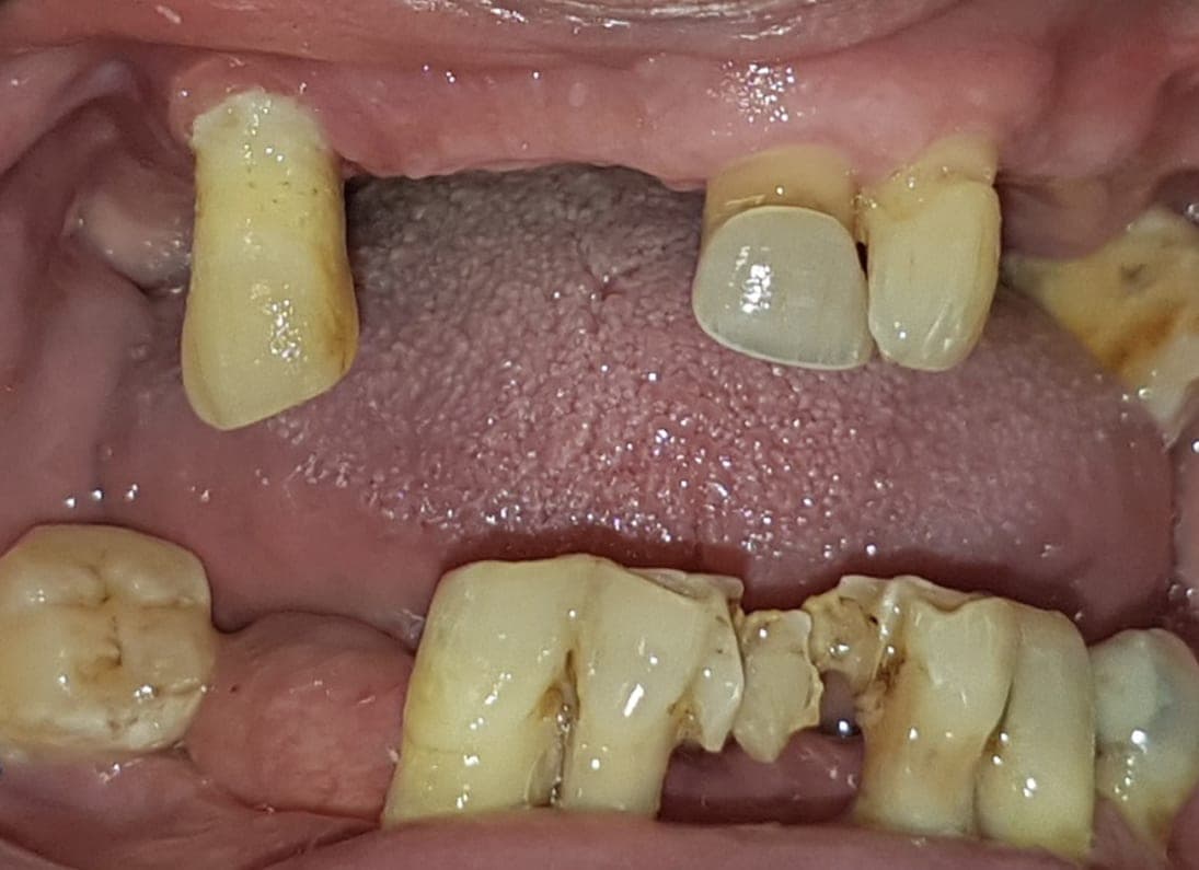 Bocca con pochi denti residui, molto compromessi