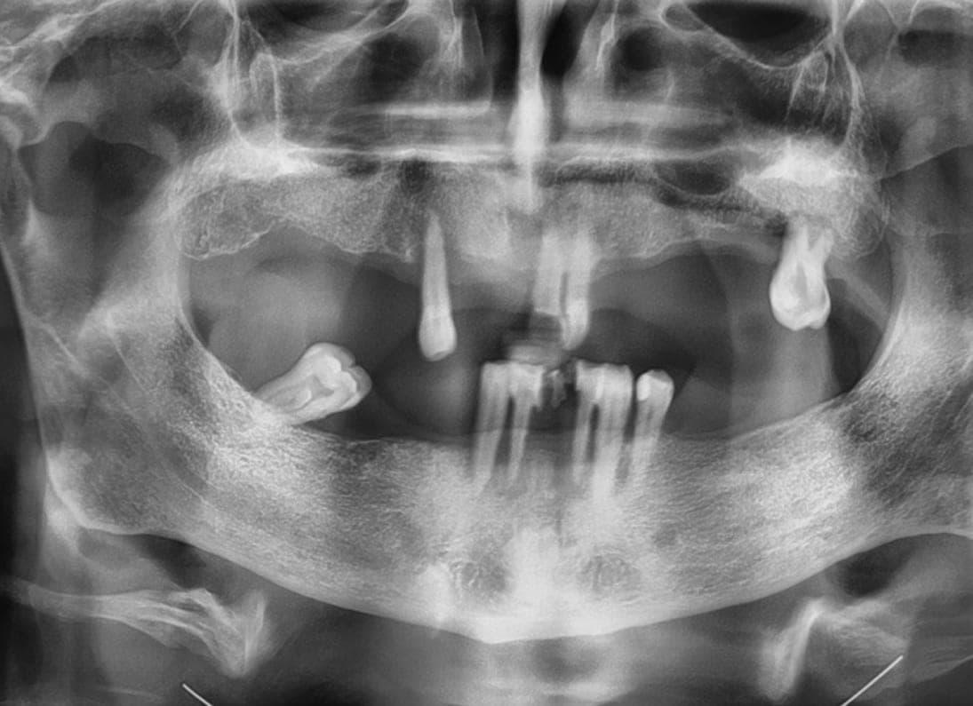 Radiografia panoramica con gli impianti inseriti