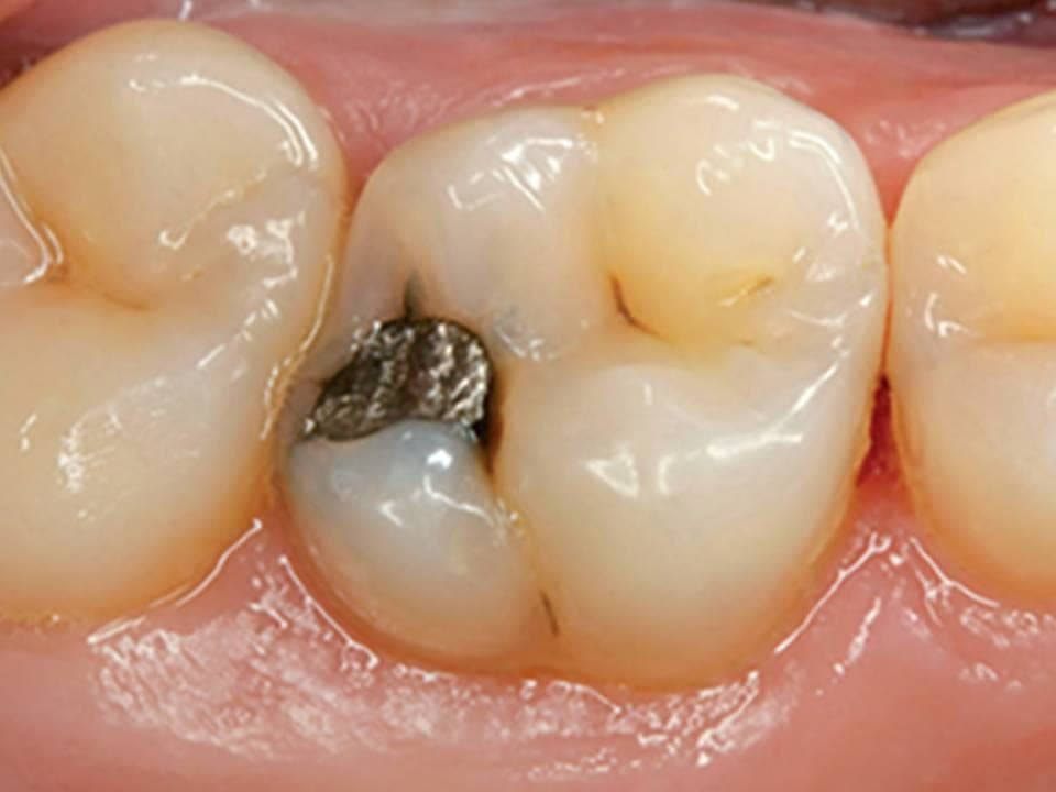 Molare con una vecchia otturazione scura e infiltrata