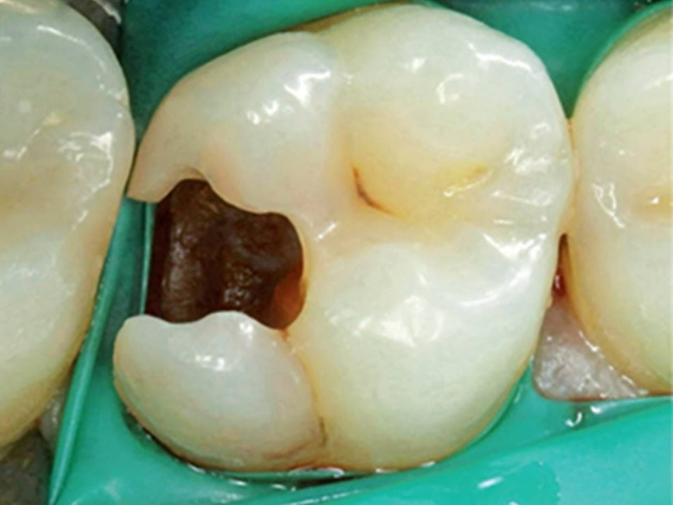 Lo stesso molare isolato con la diga di gomma, con la cavità pulita