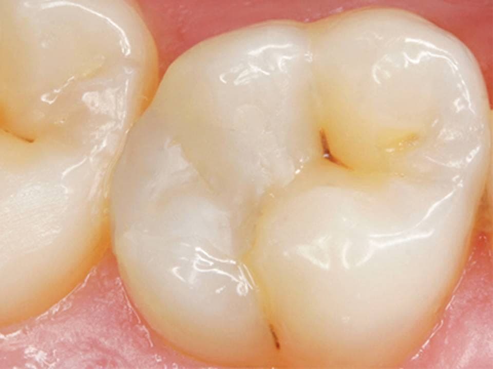 Il molare ricostruito in composito, dello stesso colore del dente