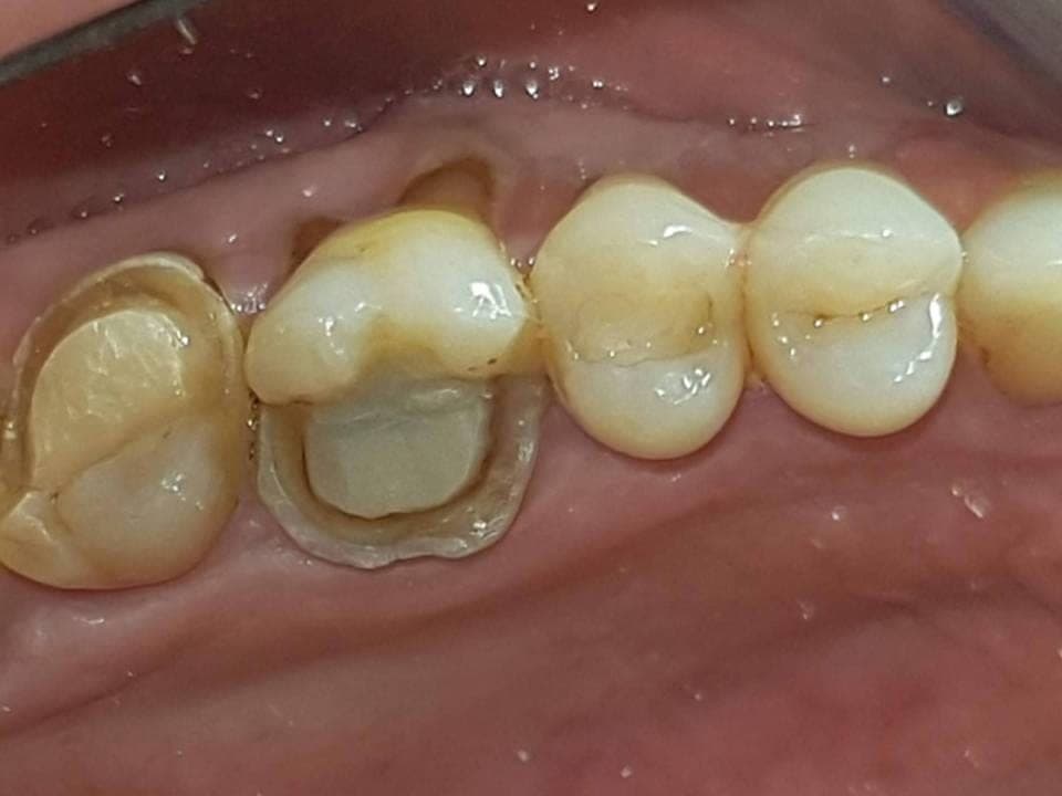 Denti posteriori preparati per accogliere gli intarsi