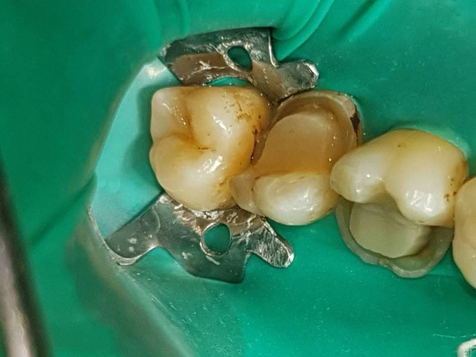 Gli stessi denti isolati con la diga di gomma prima della cementazione