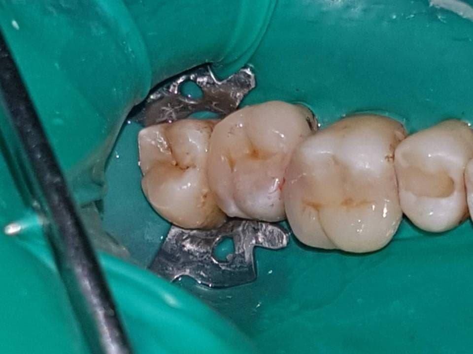 Gli intarsi cementati sui denti