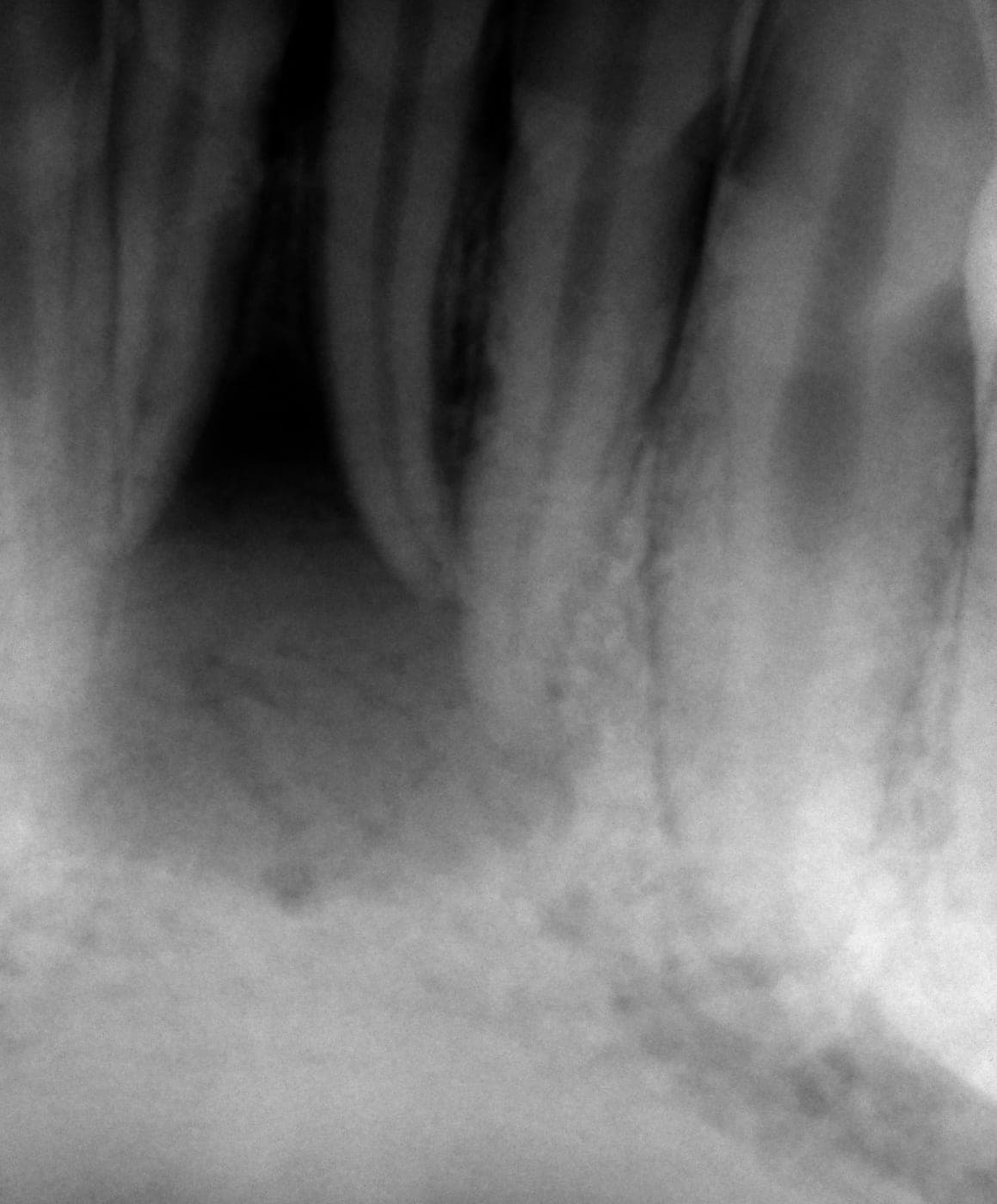 Radiografia di incisivi inferiori con una lesione alla radice