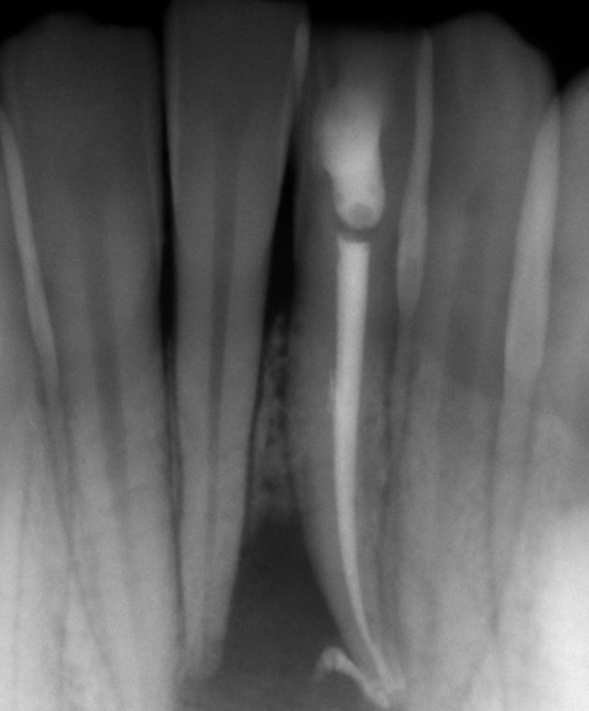 Radiografia dello stesso dente con il canale otturato