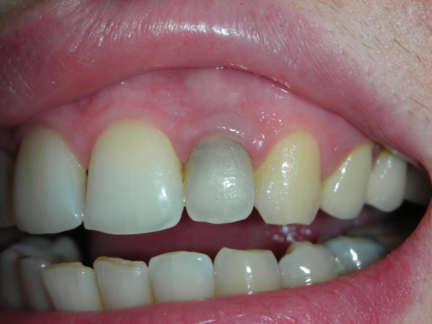 Sorriso con un incisivo superiore grigio