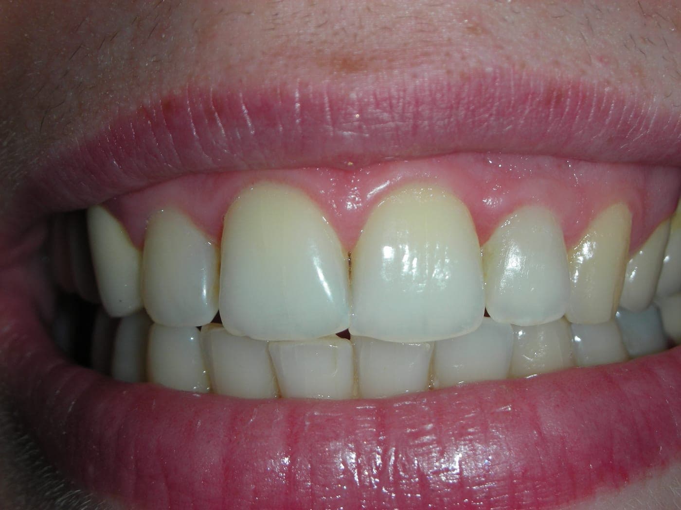 Lo stesso sorriso con l'incisivo dello stesso colore degli altri denti