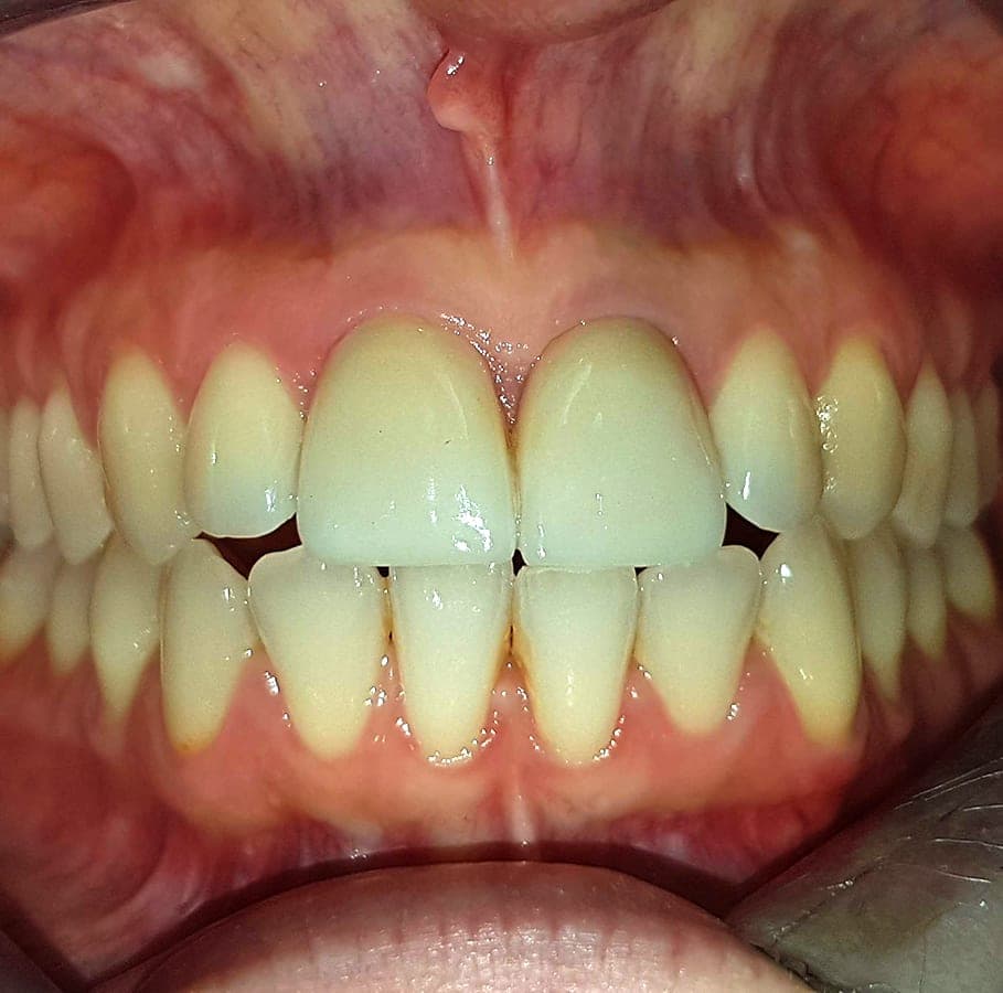 Gli stessi incisivi dello stesso colore degli altri denti