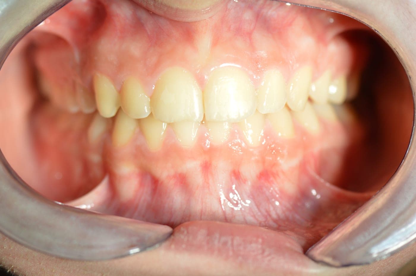 Denti allineati, vista frontale
