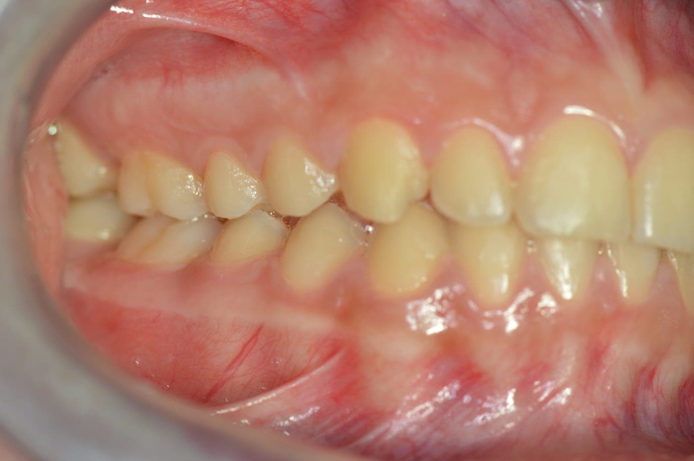 Denti allineati, lato destro