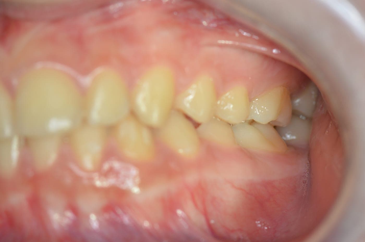 Denti allineati, lato sinistro