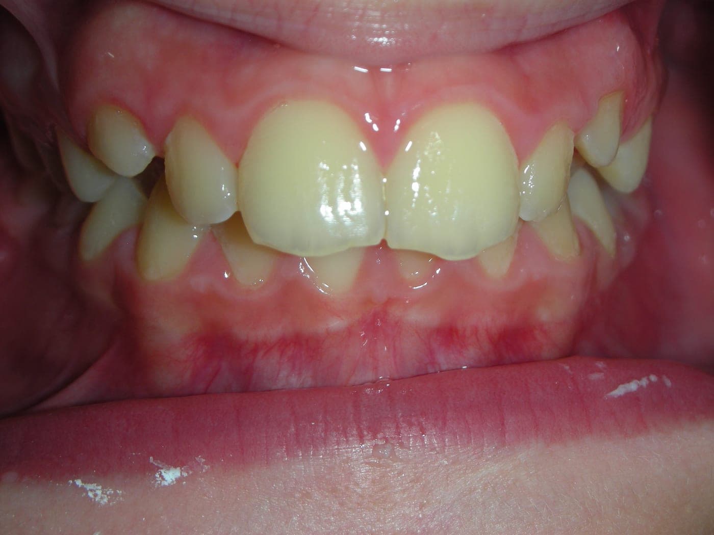 Denti anteriori disallineati, vista frontale