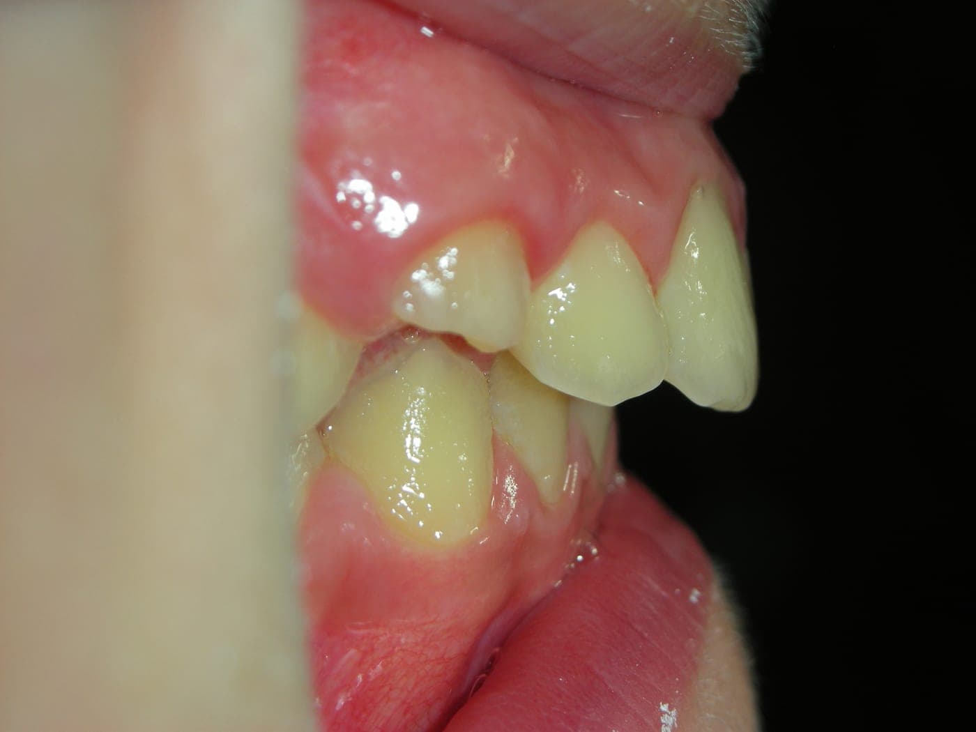 Gli stessi denti visti di lato