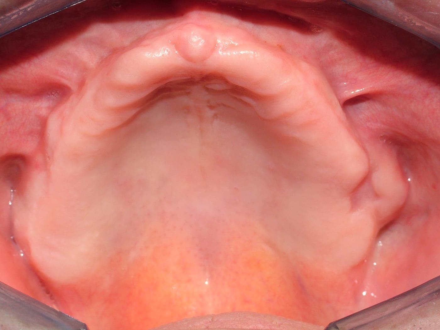 Arcata superiore senza denti
