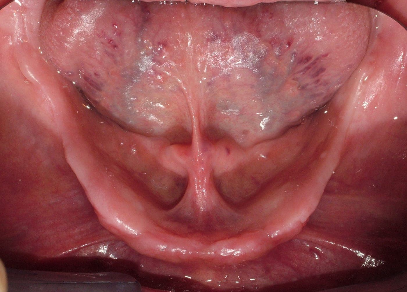Arcata inferiore senza denti