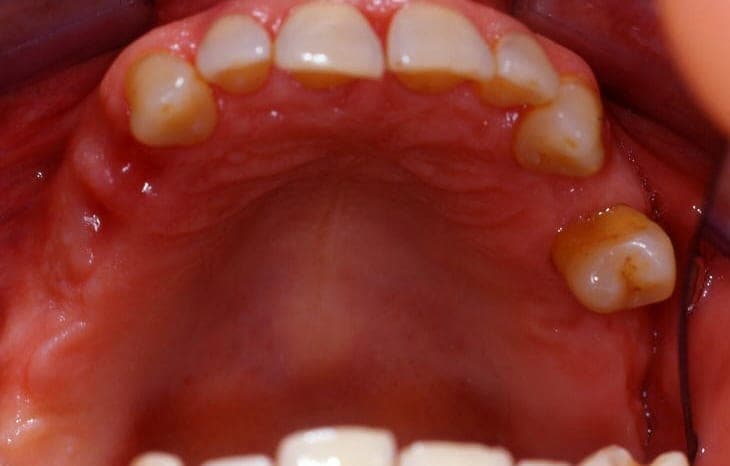 Arcata superiore con alcuni denti mancanti
