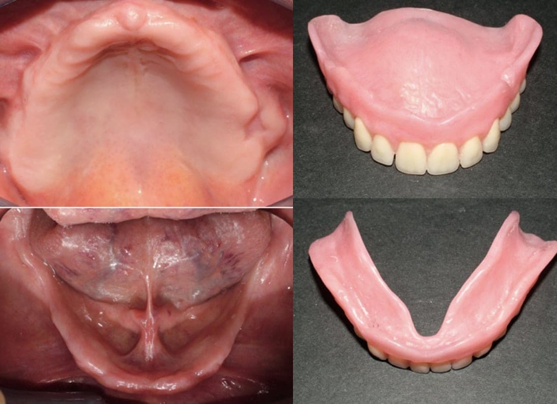Le arcate senza denti e le due protesi totali
